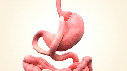 Illustration of altered upper gastrointestinal anatomy