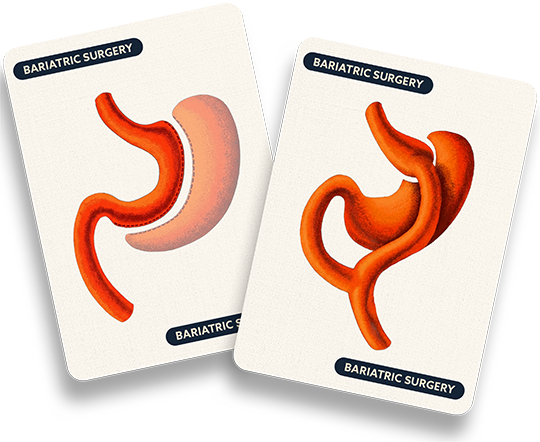 Illustration of altered stomach anatomy